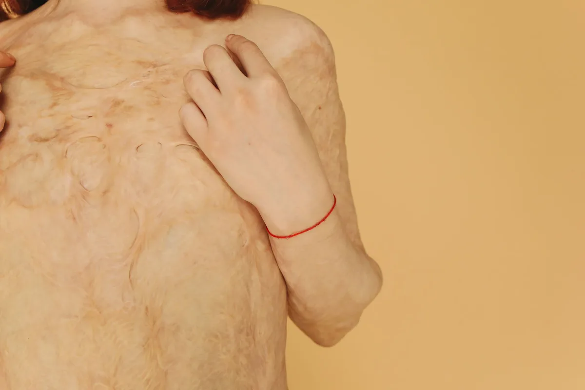 Peau montrant des rougeurs et des signes d'érythermalgie, affection vasculaire rare